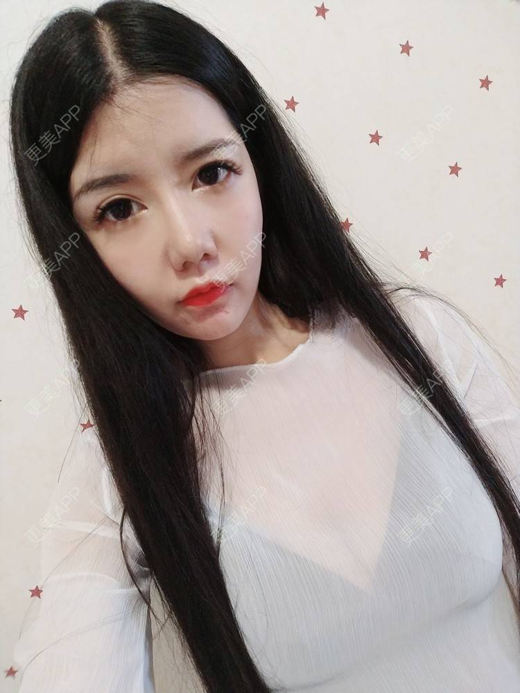 更美 - 更美用户PpObaRhcWc的假体隆胸经验 | 自体脂肪隆胸 | 假体隆胸 | 深圳