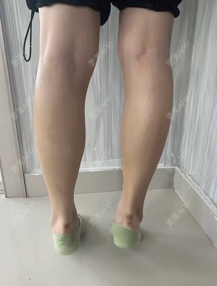 更美 - 更美用户BYgsCmMczy的注射塑形腿部经验 | 注射塑形腿部 | 广州