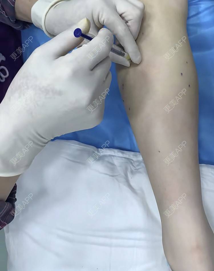 更美 - 更美用户BYgsCmMczy的注射塑形腿部经验 | 注射塑形腿部 | 广州