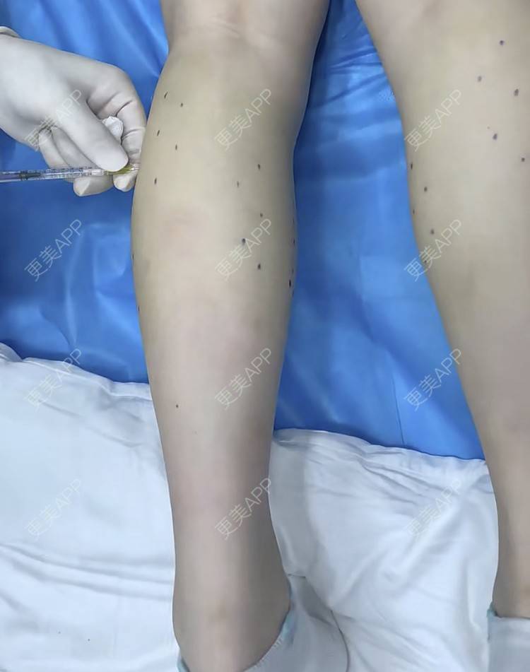更美 - 更美用户BYgsCmMczy的注射塑形腿部经验 | 注射塑形腿部 | 广州