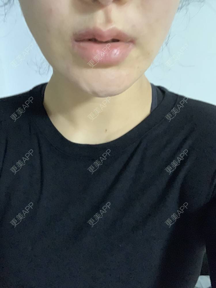 更美 - 更美用户SM4dtJKhse的厚唇改薄经验 | 厚唇改薄 | 蚌埠 | 微笑唇手术