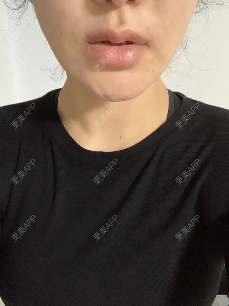 更美 - 更美用户SM4dtJKhse的厚唇改薄经验 | 厚唇改薄 | 蚌埠 | 微笑唇手术