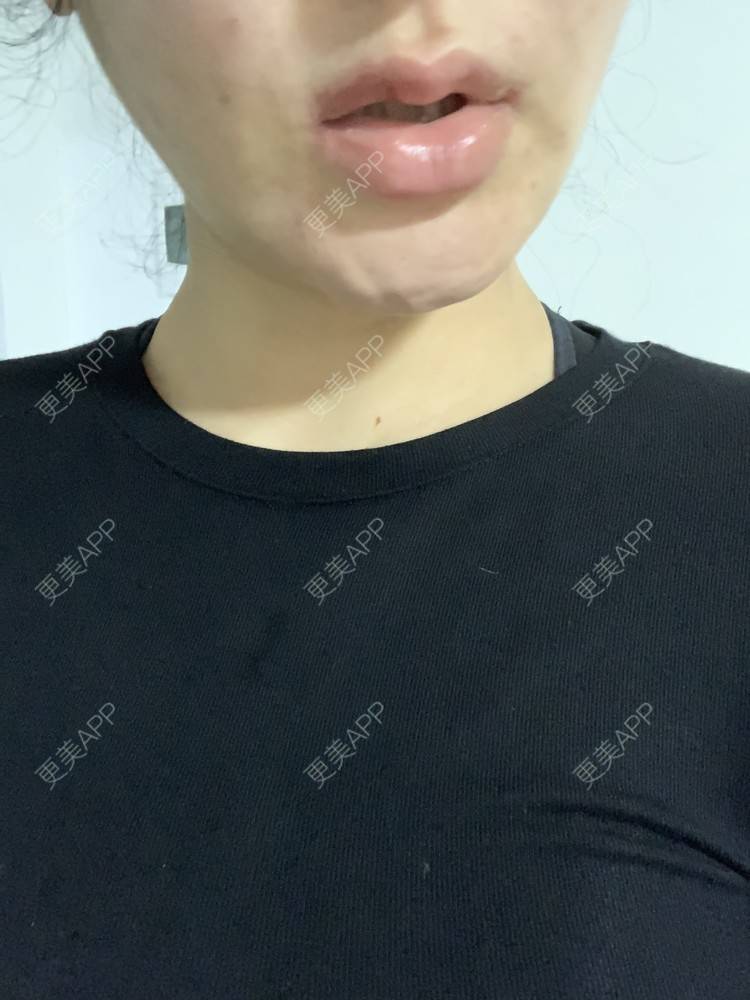 更美 - 更美用户SM4dtJKhse的厚唇改薄经验 | 厚唇改薄 | 蚌埠 | 微笑唇手术