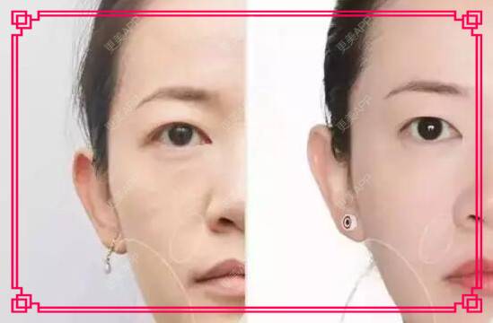 更美 - 更美用户uyp6MKWNHe的超声提升经验 | 超声提升