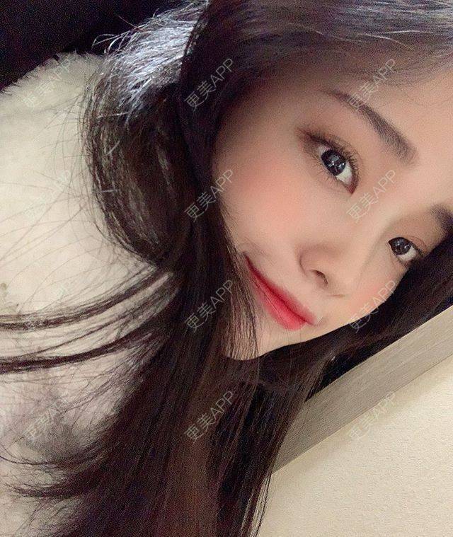 更美 - 更美用户7mVQ1aXBY0的眶隔脂肪释放经验 | 眶隔脂肪释放