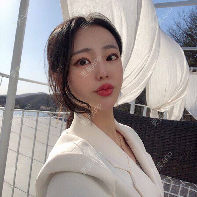 更美 - 更美用户XGZdJhYNS9的眶隔脂肪释放经验 | 眶隔脂肪释放
