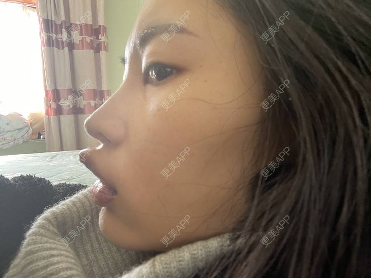 更美 - 更美用户G5frSO6DBM的唇综合经验 | 蚌埠 | 唇综合