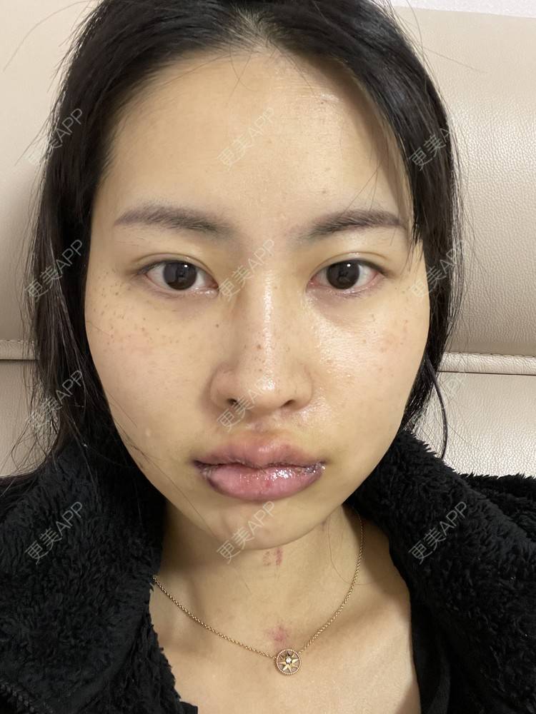 更美 - 更美用户G5frSO6DBM的唇综合经验 | 蚌埠 | 唇综合
