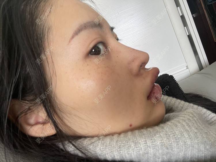 更美 - 更美用户G5frSO6DBM的唇综合经验 | 蚌埠 | 唇综合