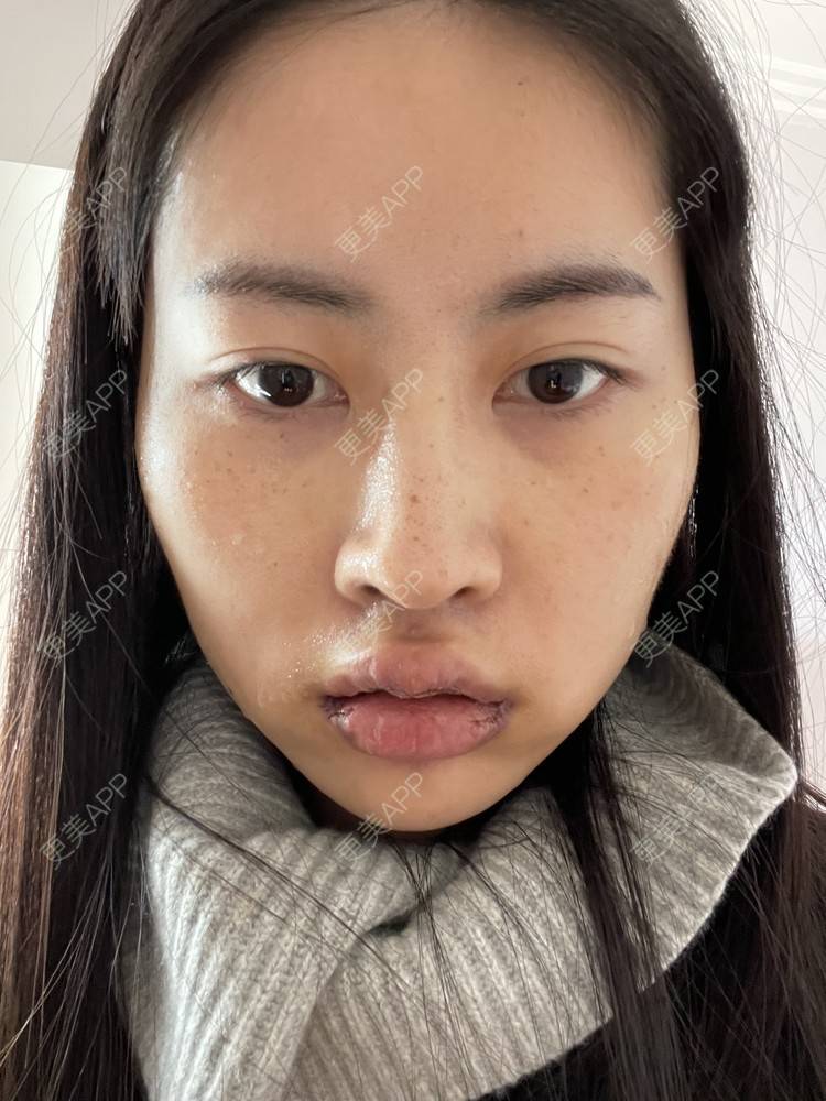更美 - 更美用户G5frSO6DBM的唇综合经验 | 蚌埠 | 唇综合