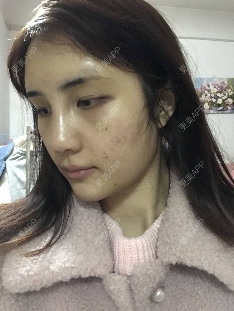 更美 - •你的小可爱•的自体脂肪垫下巴经验 | 自体脂肪垫下巴 | 自体脂肪丰太阳穴 | 深圳 | 自体脂肪垫鼻基底 | 玻尿酸溶解酶