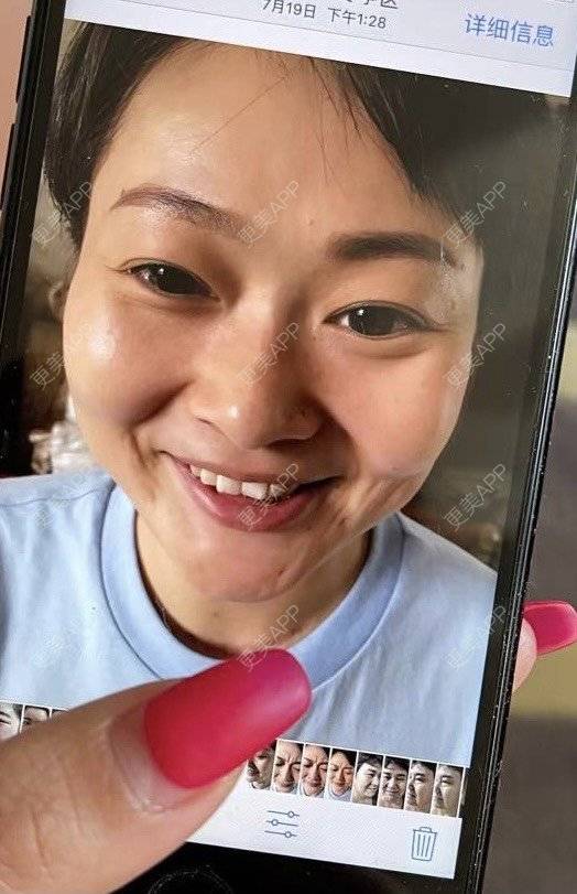 更美 - 高科技无针雾化抗衰-的除皱经验 | 除皱 | 埋线提升 | 祛皱 | 除皱套餐 | 潍坊