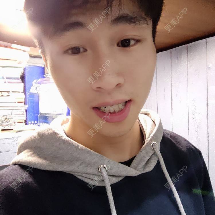 更美 - 香香aa的牙齿矫正经验 | 牙齿矫正