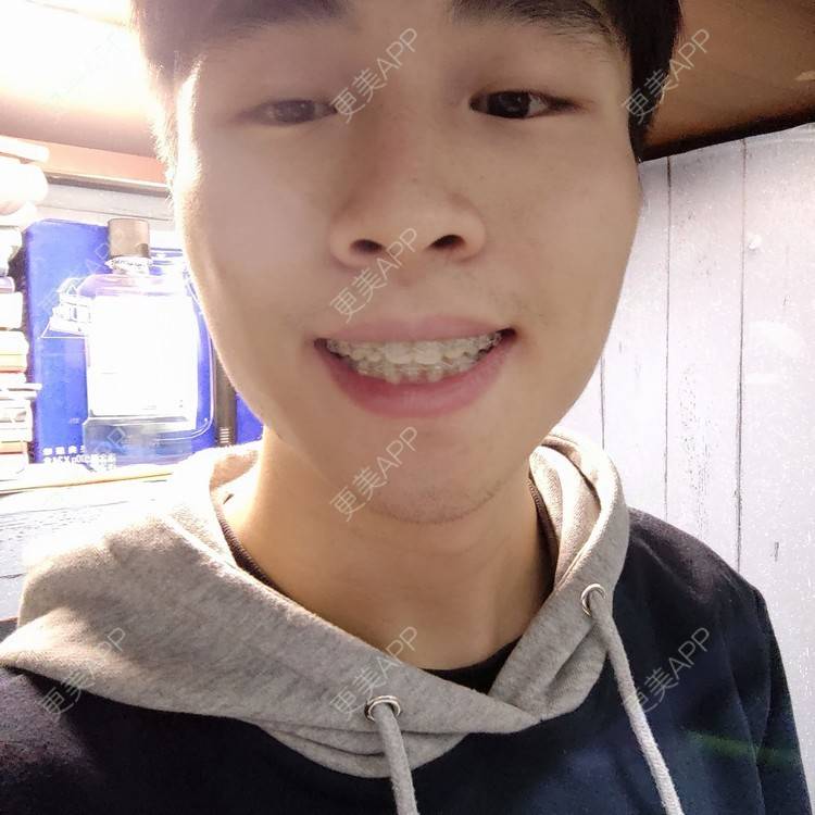 更美 - 香香aa的牙齿矫正经验 | 牙齿矫正