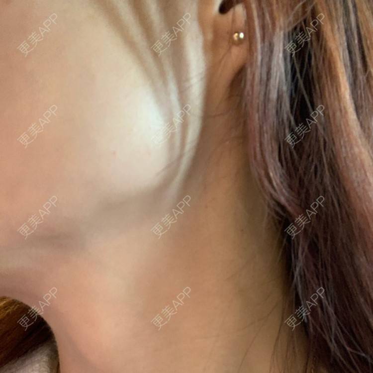 更美 - 更美用户l5RE8rSRcc的除皱瘦脸经验 | 除皱瘦脸 | 北京 | 更美研究所