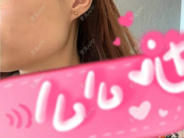 更美 - 更美用户l5RE8rSRcc的除皱瘦脸经验 | 除皱瘦脸 | 北京 | 更美研究所