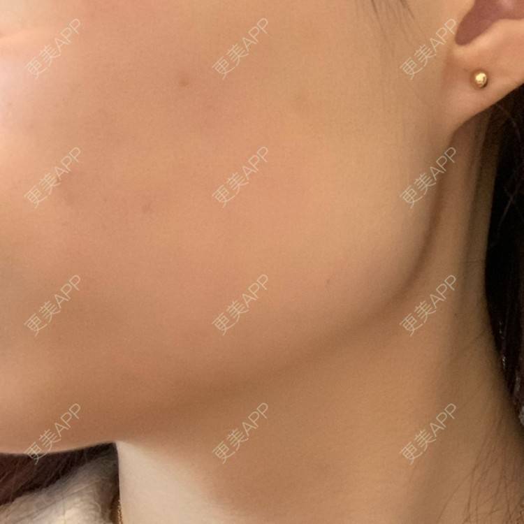 更美 - 更美用户l5RE8rSRcc的除皱瘦脸经验 | 除皱瘦脸 | 北京 | 更美研究所