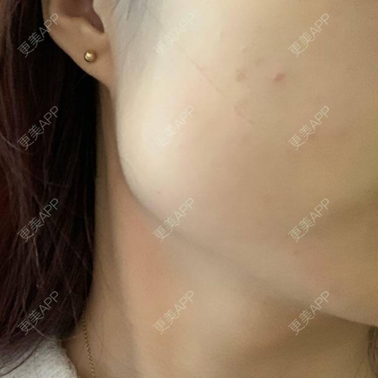 更美 - 更美用户l5RE8rSRcc的除皱瘦脸经验 | 除皱瘦脸 | 北京 | 更美研究所