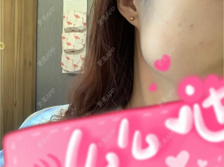 更美 - 更美用户l5RE8rSRcc的除皱瘦脸经验 | 除皱瘦脸 | 北京 | 更美研究所