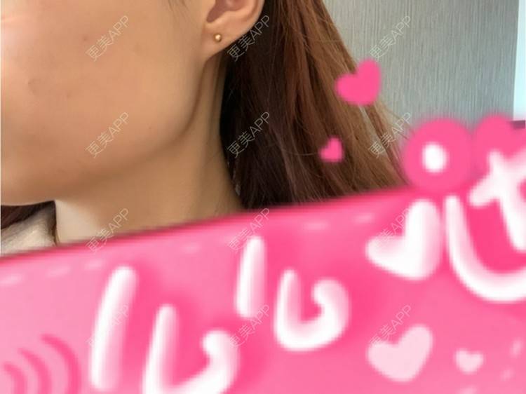 更美 - 更美用户l5RE8rSRcc的除皱瘦脸经验 | 除皱瘦脸 | 北京 | 更美研究所