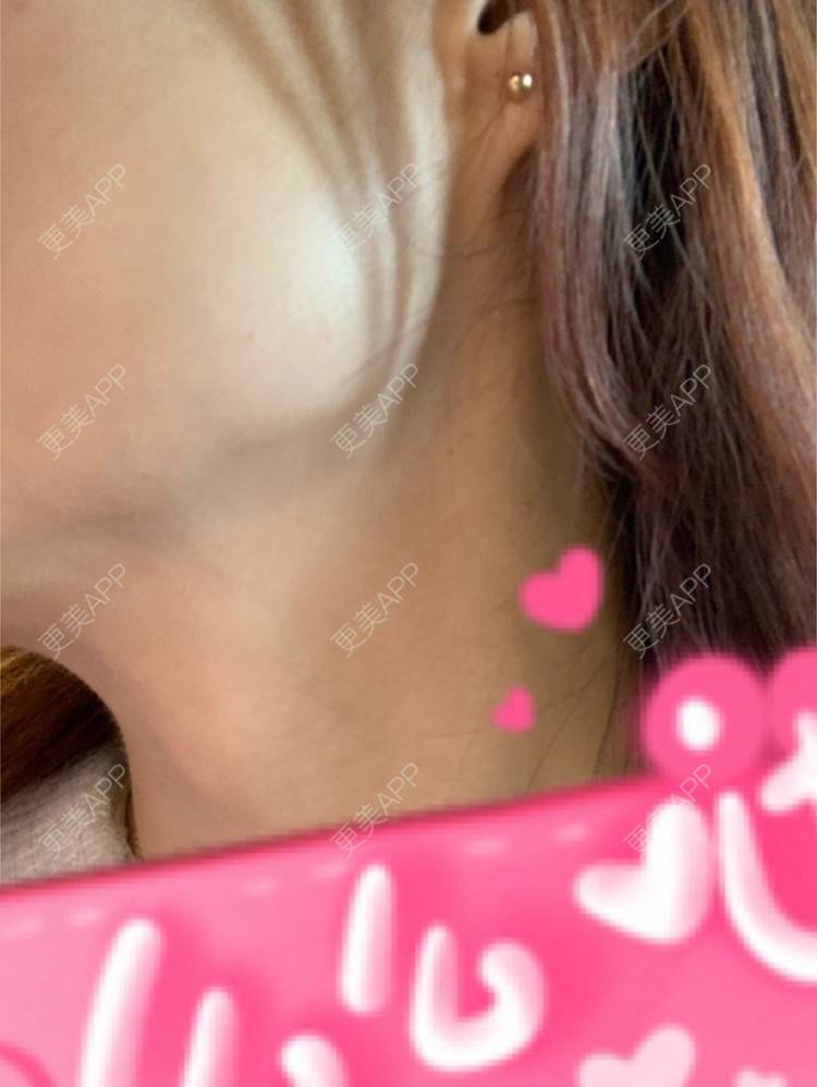 更美 - 更美用户l5RE8rSRcc的除皱瘦脸经验 | 除皱瘦脸 | 北京 | 更美研究所