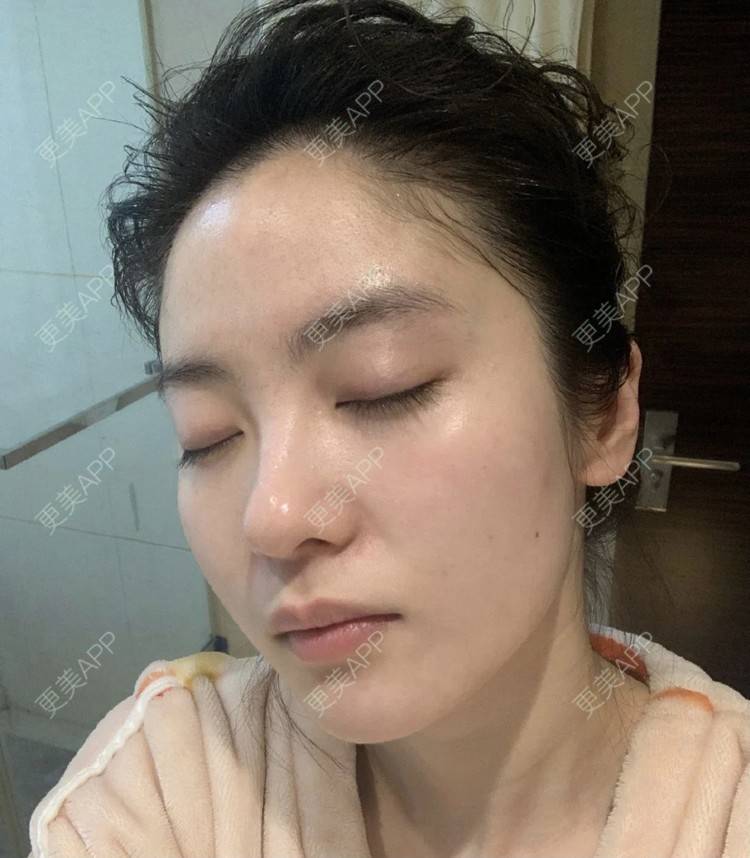 更美 - 更美用户k6deb4l9yk的微针水光经验 | 微针水光