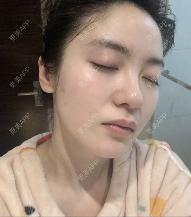 更美 - 更美用户k6deb4l9yk的微针水光经验 | 微针水光