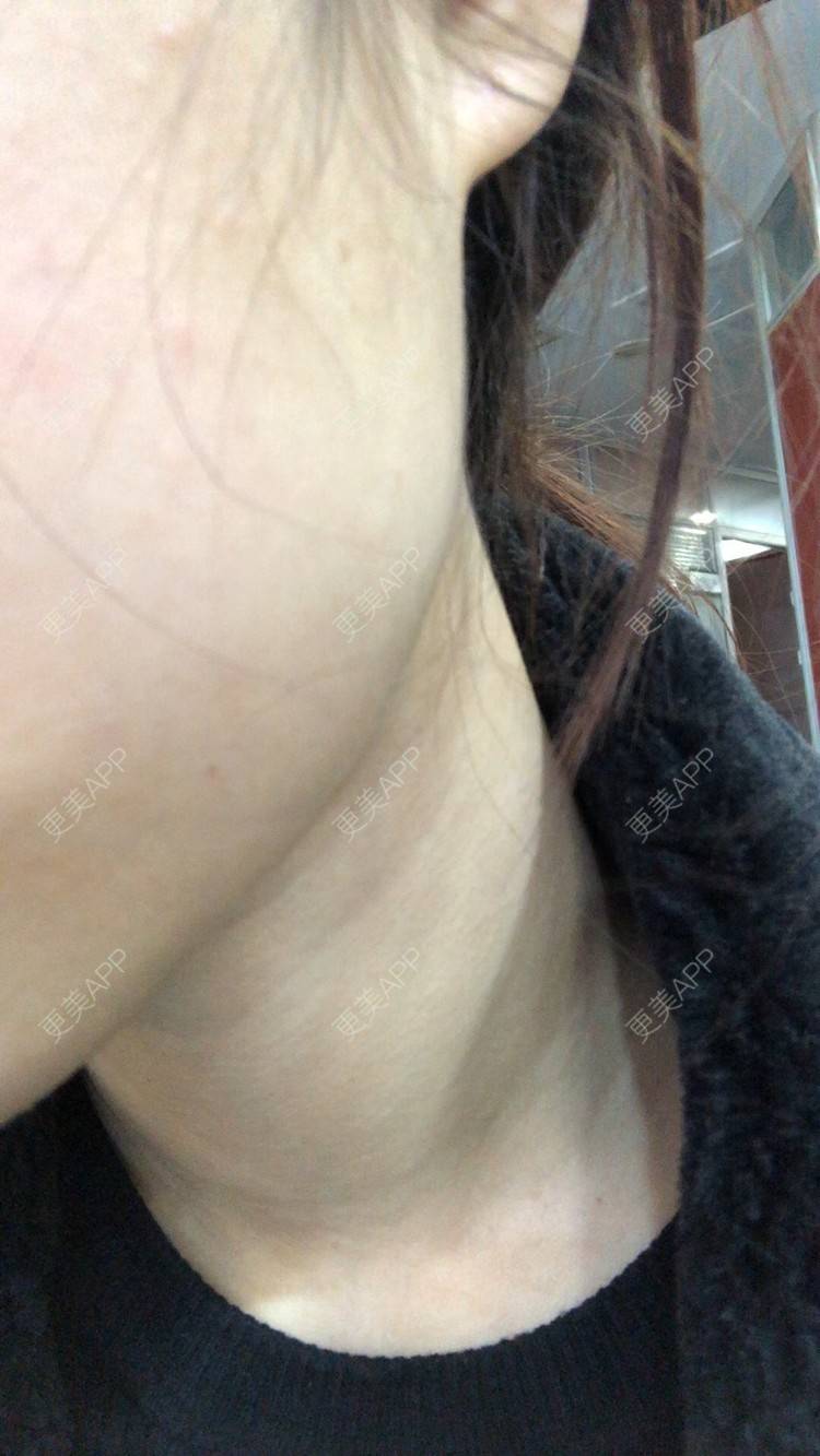 更美 - 更美用户Q1HK2tRpgz的除皱瘦脸经验 | 除皱瘦脸 | 武汉