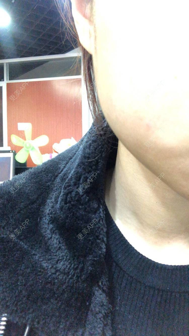 更美 - 更美用户Q1HK2tRpgz的除皱瘦脸经验 | 除皱瘦脸 | 武汉