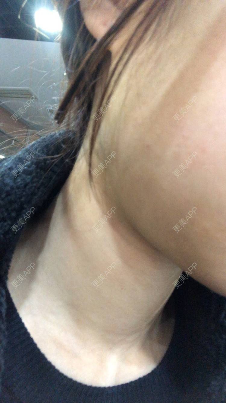 更美 - 更美用户Q1HK2tRpgz的除皱瘦脸经验 | 除皱瘦脸 | 武汉