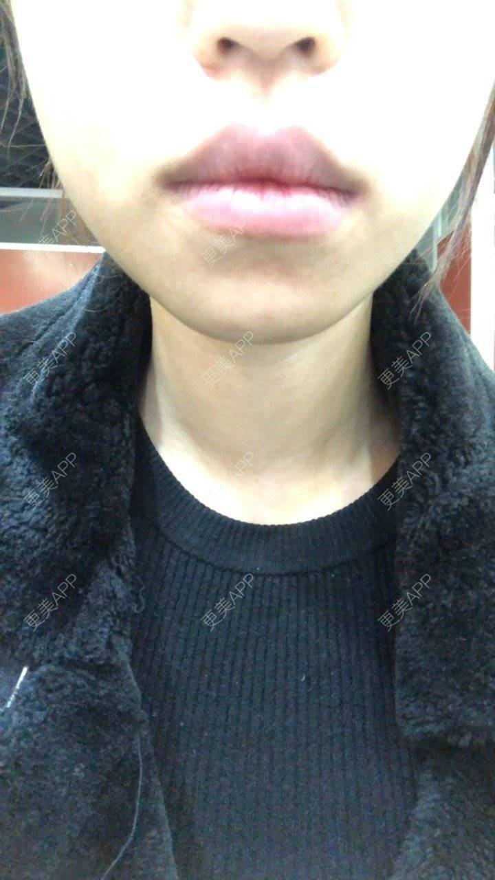 更美 - 更美用户Q1HK2tRpgz的除皱瘦脸经验 | 除皱瘦脸 | 武汉