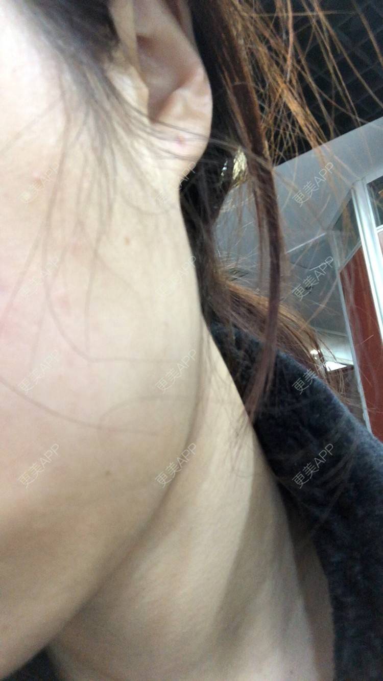 更美 - 更美用户Q1HK2tRpgz的除皱瘦脸经验 | 除皱瘦脸 | 武汉