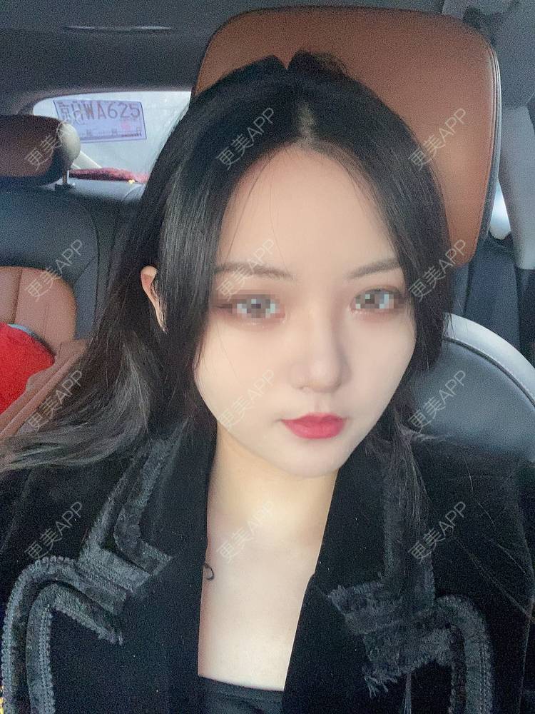 更美 - 更美用户IDTDkSmVXl的光纤溶脂经验 | 光纤溶脂 | 北京
