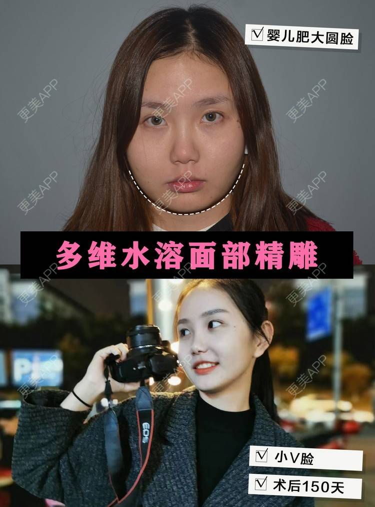 更美 - 菠萝蜜双双的吸脂瘦脸经验 | 吸脂瘦脸 | 长沙 | 瘦脸