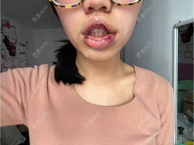 更美 - 全世界最开心的女孩子的唇综合经验 | 蚌埠 | 唇综合