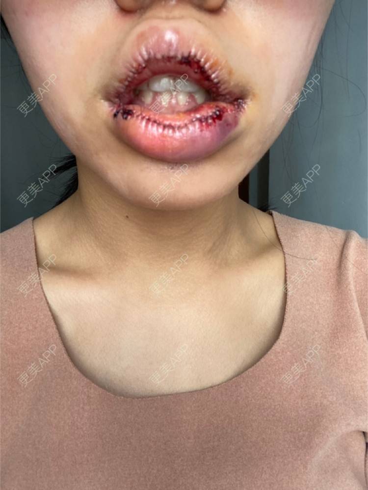 更美 - 全世界最开心的女孩子的唇综合经验 | 蚌埠 | 唇综合