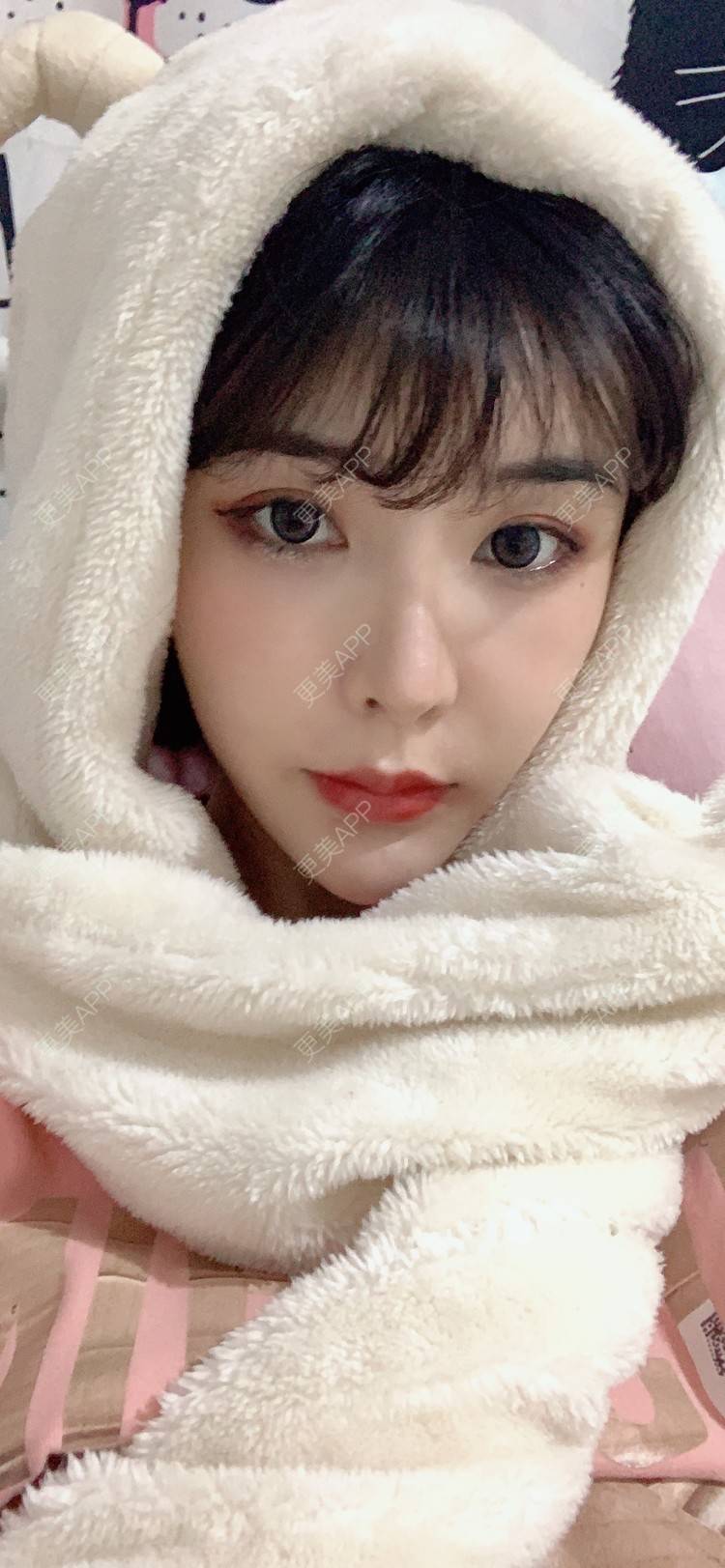 更美 - 更美用户tQrsyaKGg8的肋软骨隆鼻经验 | 北京 | 肋软骨隆鼻