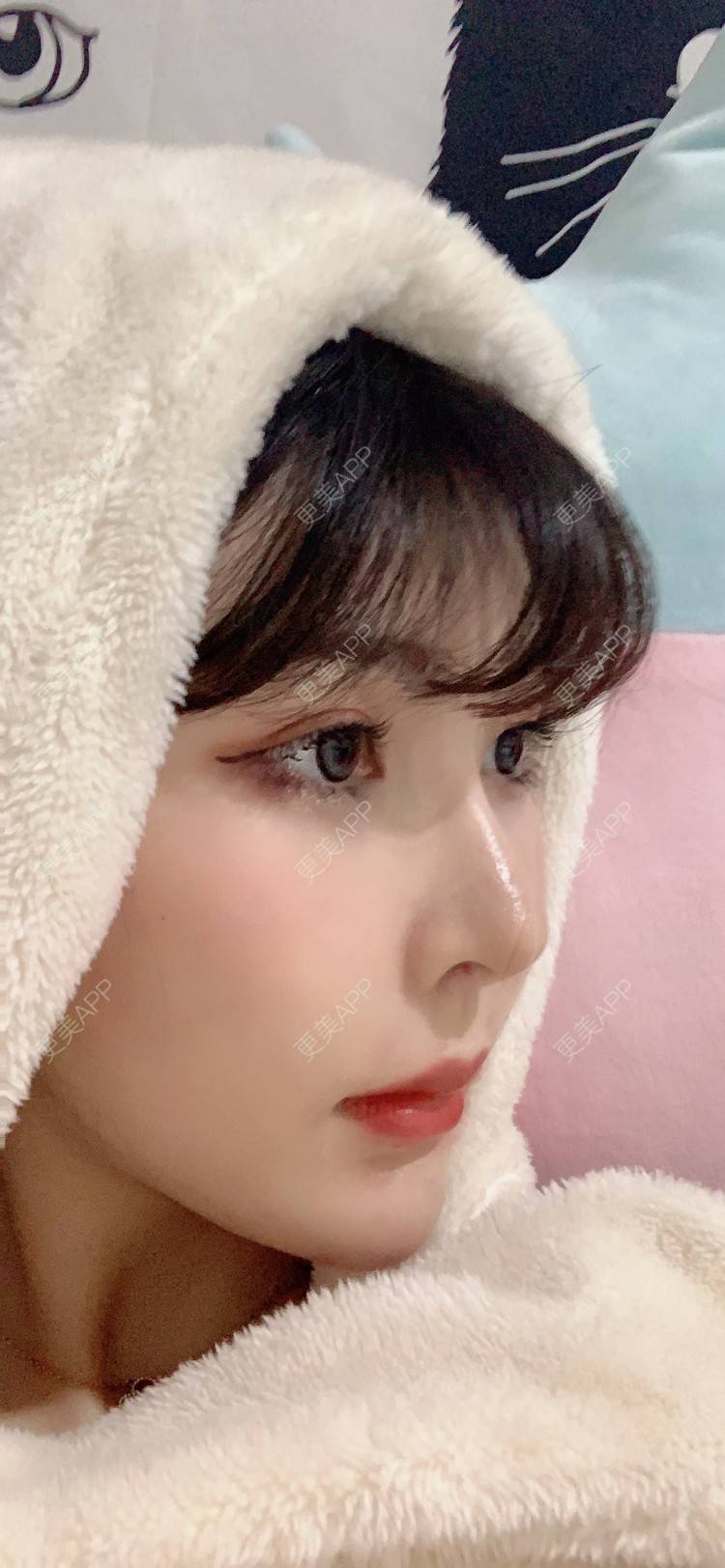 更美 - 更美用户tQrsyaKGg8的肋软骨隆鼻经验 | 北京 | 肋软骨隆鼻