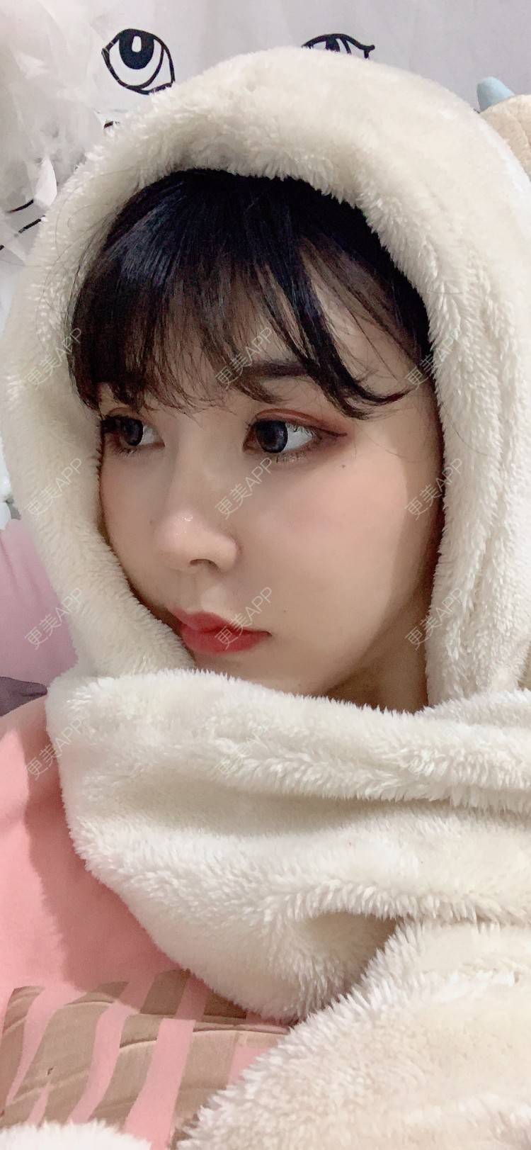 更美 - 更美用户tQrsyaKGg8的肋软骨隆鼻经验 | 北京 | 肋软骨隆鼻