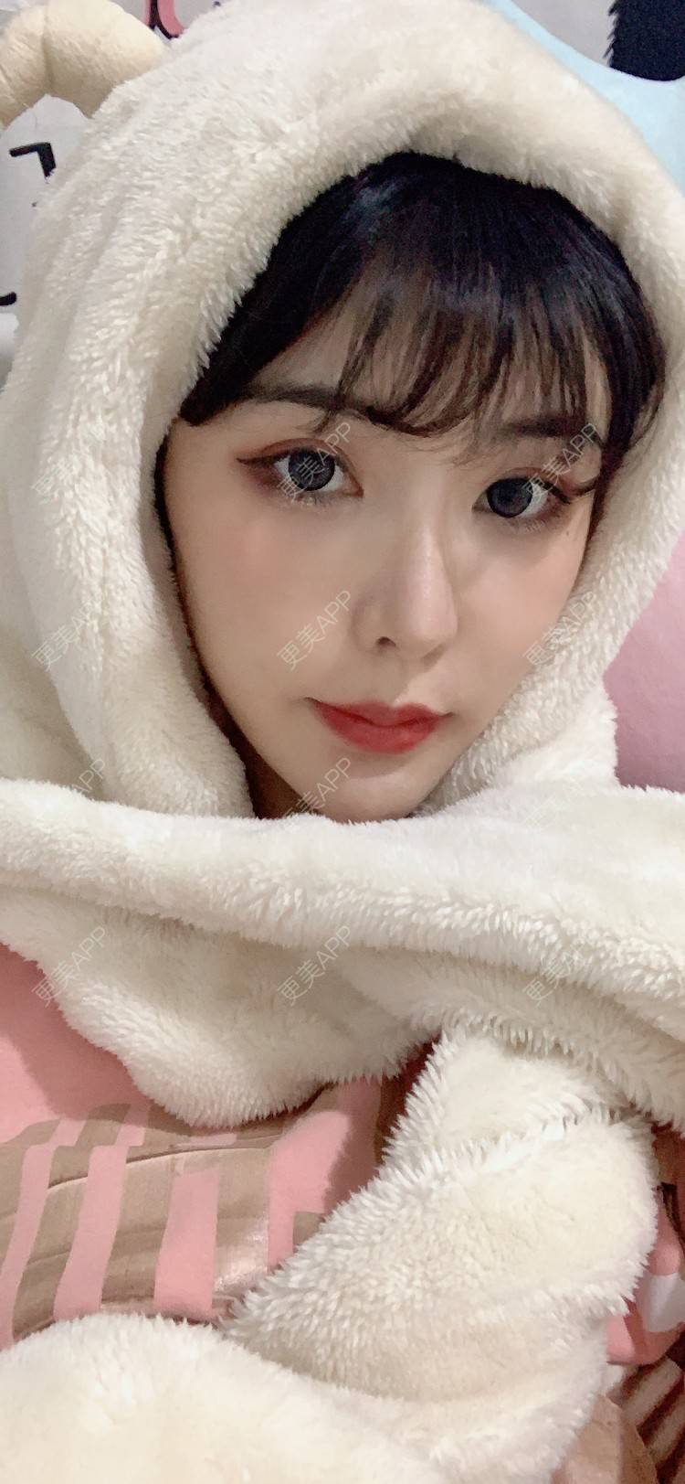 更美 - 更美用户tQrsyaKGg8的肋软骨隆鼻经验 | 北京 | 肋软骨隆鼻