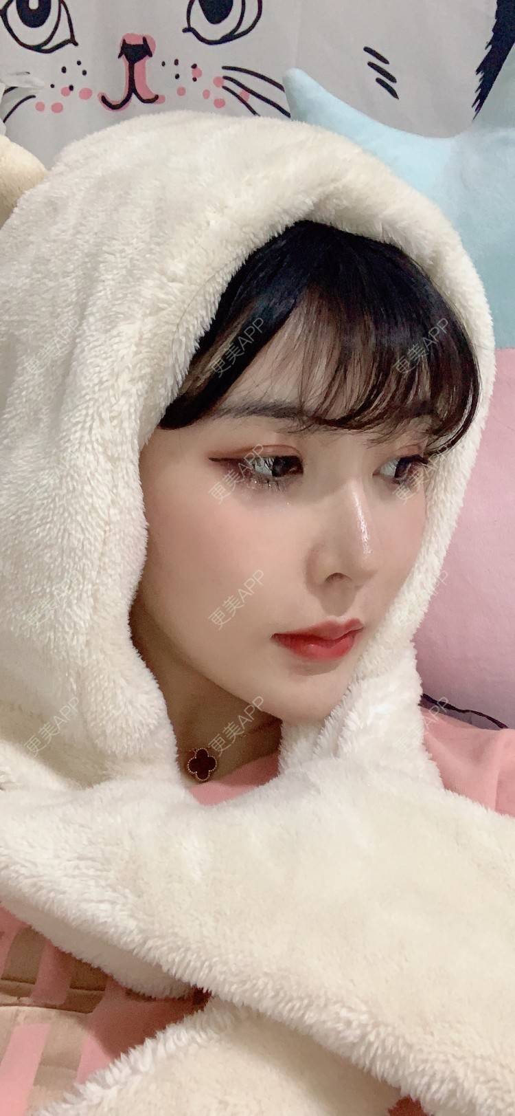 更美 - 更美用户tQrsyaKGg8的肋软骨隆鼻经验 | 北京 | 肋软骨隆鼻