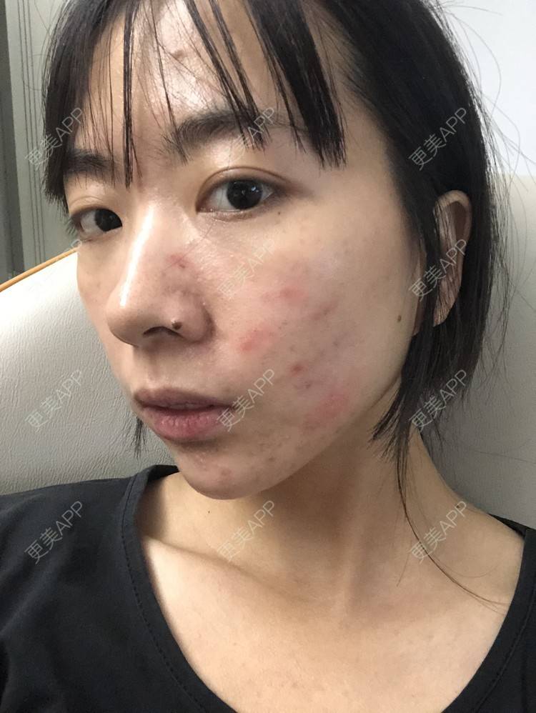 更美 - 抛却悲喜跟你走逞的祛疤痕痘印经验 | 祛疤痕痘印 | 皮肤综合管理套餐 | 皮肤检测 | 成都