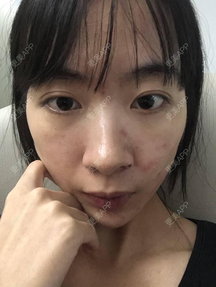 更美 - 抛却悲喜跟你走逞的祛疤痕痘印经验 | 祛疤痕痘印 | 皮肤综合管理套餐 | 皮肤检测 | 成都