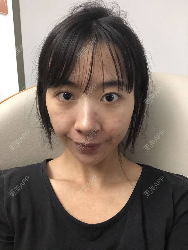 更美 - 抛却悲喜跟你走逞的祛疤痕痘印经验 | 祛疤痕痘印 | 皮肤综合管理套餐 | 皮肤检测 | 成都