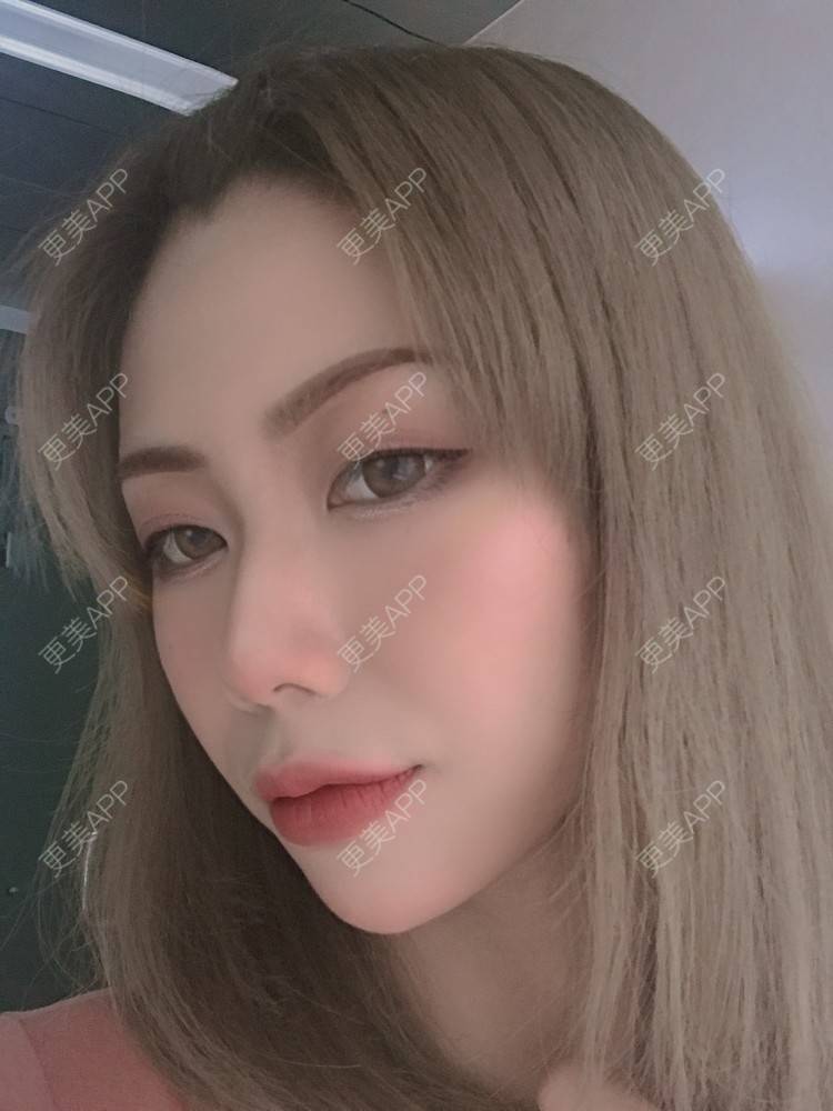 更美 - 更美用户o78UJZ3TiM的埋线除皱经验 | 埋线除皱
