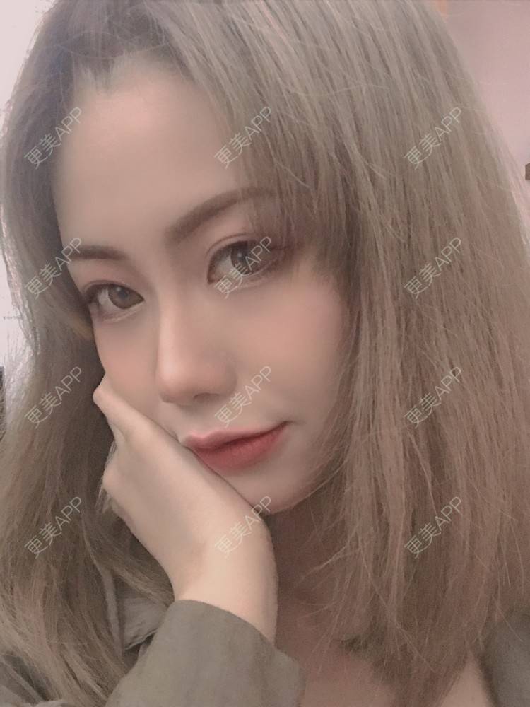 更美 - 更美用户o78UJZ3TiM的埋线除皱经验 | 埋线除皱
