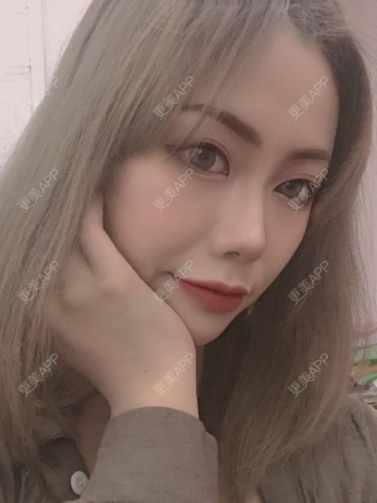更美 - 更美用户o78UJZ3TiM的埋线除皱经验 | 埋线除皱