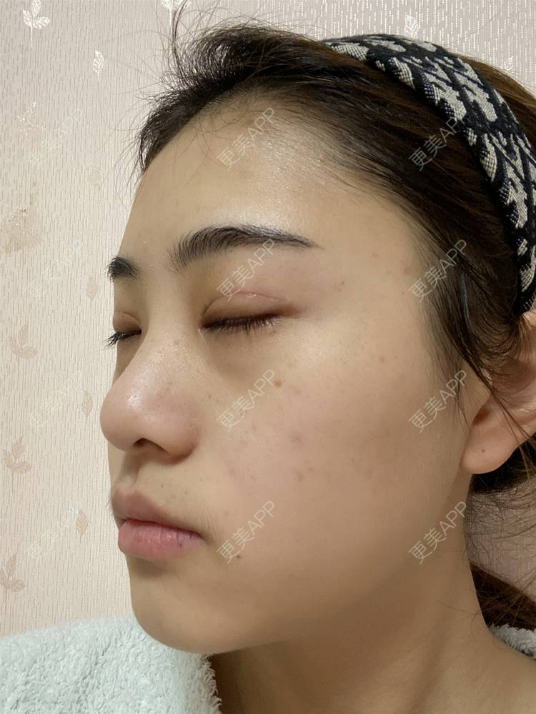 更美 - 鲸落鲸起的全切双眼皮经验 | 全切双眼皮 | 开内眼角 | 开外眼角 | 眼睑下至 | 重庆