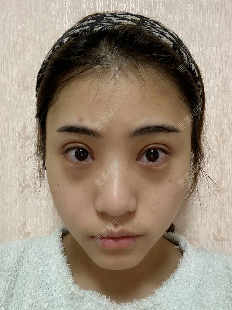 更美 - 鲸落鲸起的全切双眼皮经验 | 全切双眼皮 | 开内眼角 | 开外眼角 | 眼睑下至 | 重庆