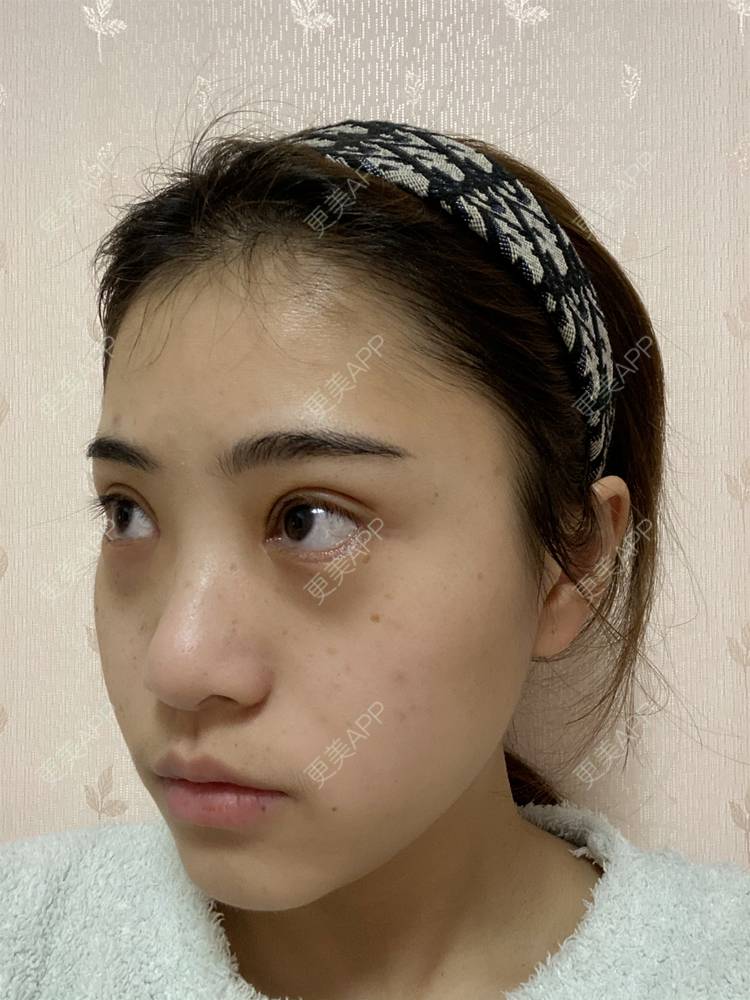 更美 - 鲸落鲸起的全切双眼皮经验 | 全切双眼皮 | 开内眼角 | 开外眼角 | 眼睑下至 | 重庆